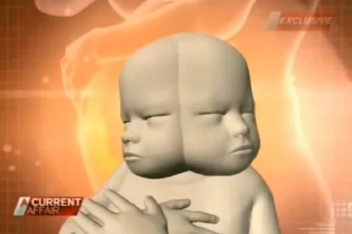  Bào thai có 2 khuôn mặt và 2 bộ não dính liền