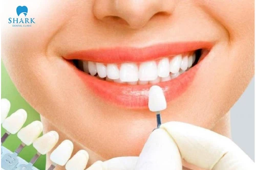 Nha khoa Shark áp dụng công nghệ dán răng sứ Veneer chất lượng
