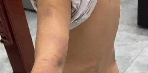 Xác minh hình ảnh bé trai bị đánh tím người tại Hưng Yên
