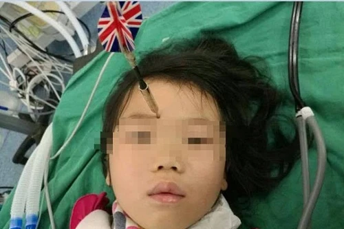 Anh trai lỡ ném phi tiêu trúng mặt em gái