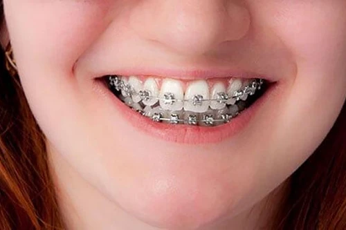 Bật mí cách niềng răng tiết kiệm 