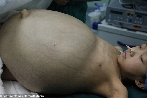 Cận cảnh ca mổ u quái Teratoma khổng lồ ở Trung Quốc
