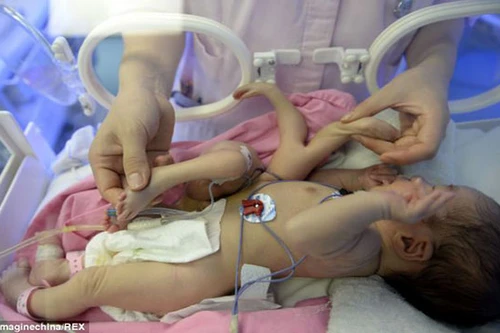 Trung Quốc: Phẫu thuật thành công bé trai 4 tay, 4 chân