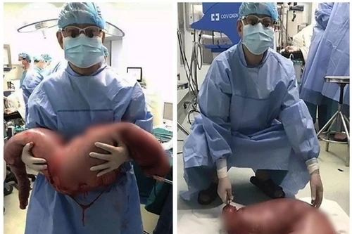 Cắt bỏ đoạn ruột già nặng 13kg của thanh niên bị táo bón 22 năm
