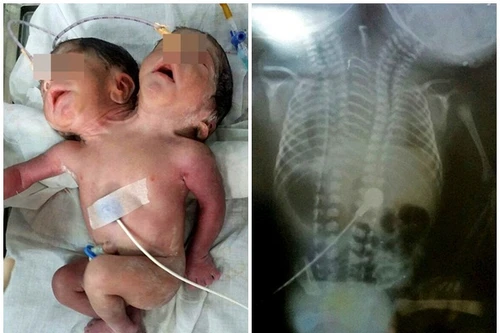 Bé trai 2 đầu qua đời 32 tiếng đồng hồ sau khi sinh