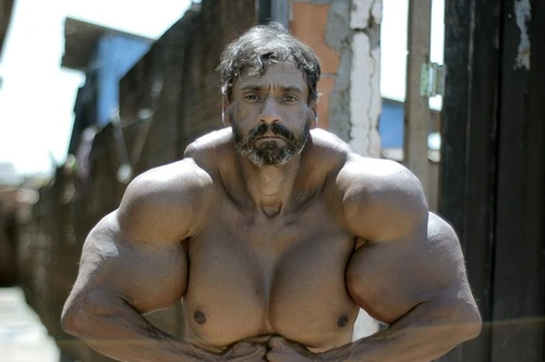 Nghiện tiêm dầu để có bắp tay khủng như người khổng lồ xanh 