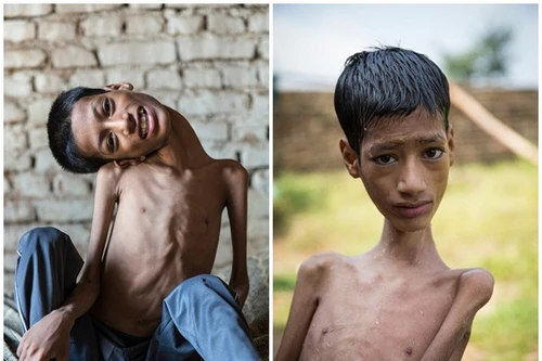 Cuộc sống thay đổi của cậu bé cổ lệch từng gây sốc cả thế giới