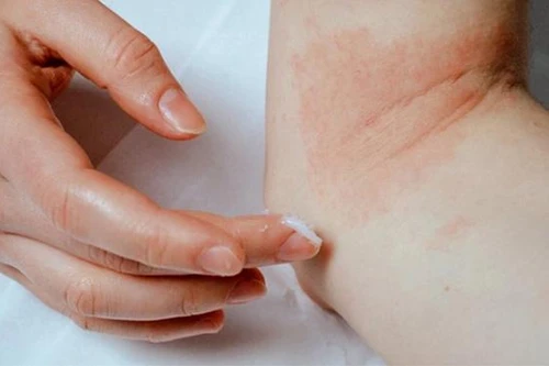 Đình chỉ lưu hành toàn quốc kem bôi ngoài da TRANZAZA do không đạt chất lượng