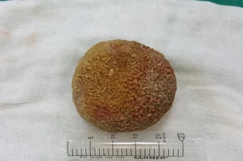 Kỳ lạ: Ông lão có viên sỏi nặng nửa cân trong bàng quang