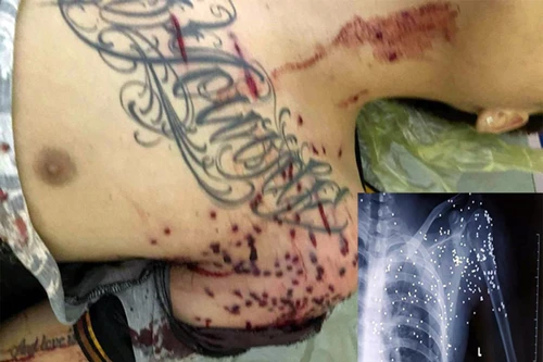 Nam thanh niên bị kẻ lạ mặt dùng súng hoa cải bắn đang nguy kịch