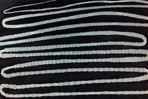 Sán dây 6,2m làm tổ trong dạ dày của người đàn ông thích ăn thịt bò tái