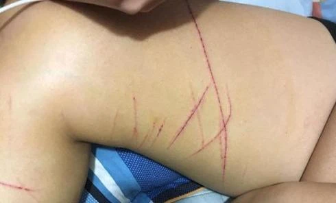 Truy tìm kẻ rạch đùi, chân nữ sinh tại Hà Nội