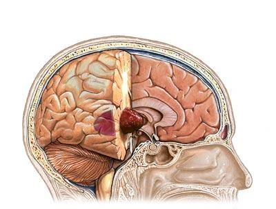 Nhận diện các triệu chứng ung thư não