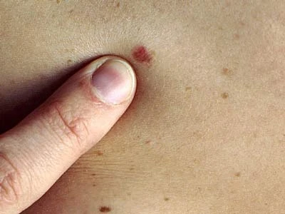 Nhận diện các dấu hiệu cảnh báo ung thư da