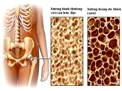 Tuân thủ 5 bước để phòng ngừa loãng xương