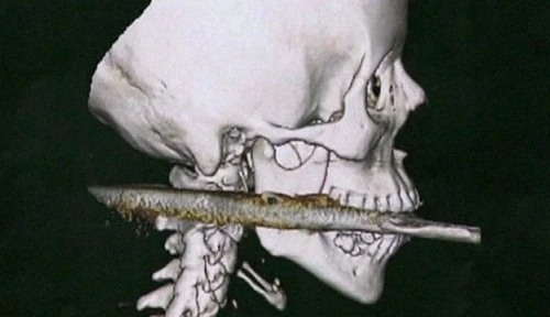 Bị lao đâm xuyên cuống họng vẫn sống sót