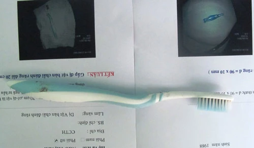 Nuốt phải bàn chải đánh răng vì mải buôn điện thoại