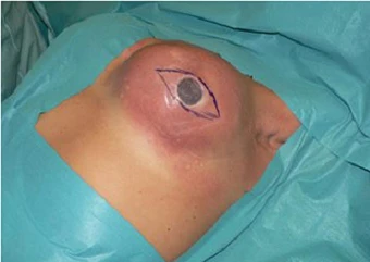 Muỗi đốt làm vỡ ngực giả