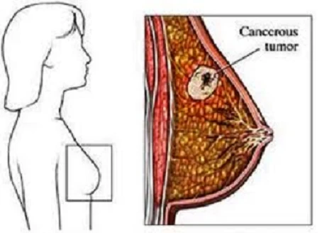 Thuốc mới cho thấy triển vọng điều trị ung thư vú 