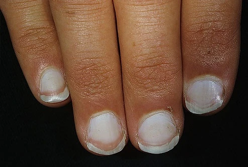 Móng tay nói gì về sức khỏe của bạn?