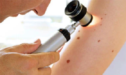 Bạn có nguy cơ bị u hắc tố?