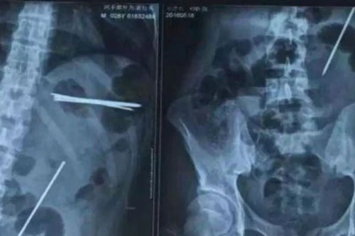 Nuốt đinh sắt để... gây ấn tượng 