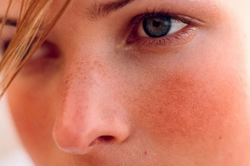 Bệnh rosacea liên quan đến Alzheimer