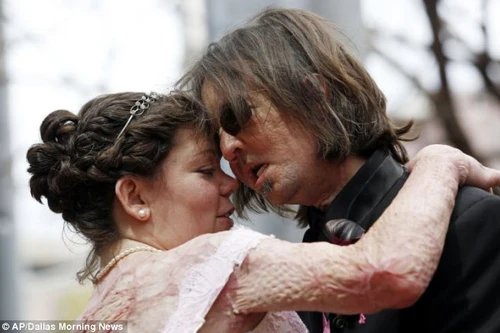 Người Mĩ đầu tiên được cấy mặt đã kết hôn