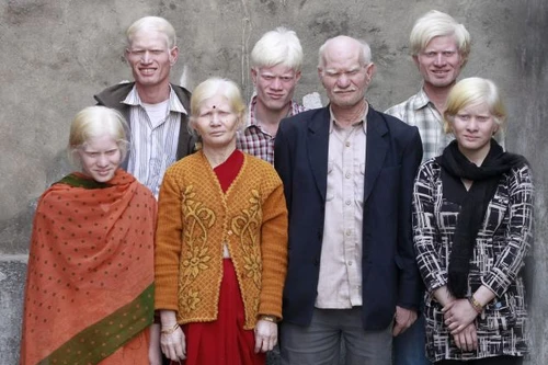 Kỷ lục 10 người mắc bệnh bạch tạng trong một gia đình.