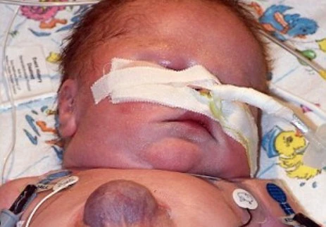 Ca đầu tiên trên thế giới sống sót với quả tim ngoài lồng ngực