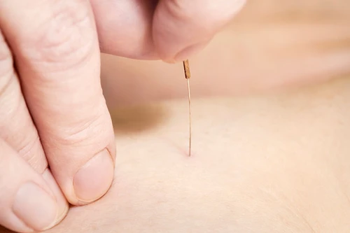 Thụy Sĩ: 16 người nhiễm HIV vì châm cứu