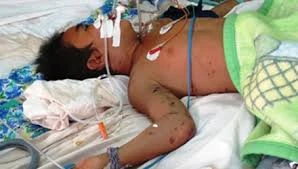 Hà Nội: Gần 50 học sinh tiểu học nhập viện cấp cứu vì ong đốt