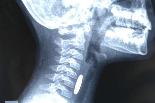 Nuốt đồ chơi, bé gái bị thủng thực quản suốt 2 năm mà không biết ​