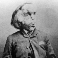 [ẢNH] 20 căn bệnh hiếm gặp nhất thế giới