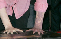 [ẢNH] 20 căn bệnh hiếm gặp nhất thế giới