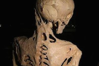 [ẢNH] 20 căn bệnh hiếm gặp nhất thế giới