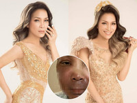 1 tháng sau vụ bỏng, Hồng Ngọc xuất hiện với hình ảnh không thể tin nổi