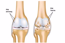 Những điều cần biết về cách chữa trị bệnh thoái hóa khớp