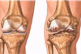 Viêm khớp gối đang tấn công lứa tuổi trẻ hơn