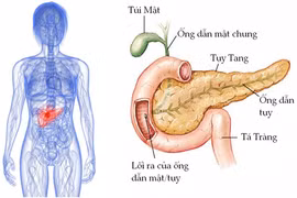 Dấu hiệu bất thường cảnh báo ung thư tuyến tụy
