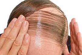 Trị liệu mới cho bệnh hói đầu và bạc tóc