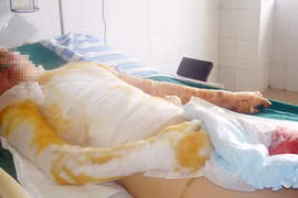 Người yêu không chịu cưới, tẩm xăng đốt cả đôi