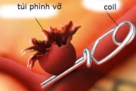 Cứu sống bé 11 tuổi bị vỡ túi phình mạch máu não 