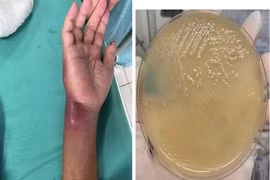 Hai bệnh nhân nhiễm vi khuẩn "ăn thịt người" ở Hòa Bình diễn biến nặng, một ca nguy kịch
