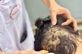 Bé gái 5 tuổi ở Hà Nội nhập viện với hơn 10 vết thương do chó cắn