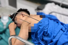 Cứu nam thanh niên 17 tuổi bị cây đinh ba tự chế đâm vào tim