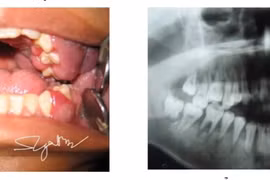 Đi khám viêm lợi, nam sinh 16 tuổi được phát hiện ung thư máu