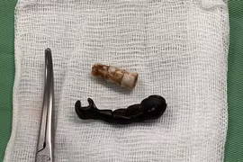 Gắp ra cánh tay đồ chơi siêu nhân bằng nhựa, đầu bút từ âm đạo bé 5 tuổi