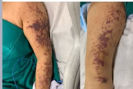Một phụ nữ ở Hà Nội nhập viện cấp cứu sau 2 ngày ăn lòng lợn