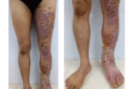 Nữ bệnh nhân mắc căn bệnh nấm da được WHO gọi là bệnh nhiệt đới “bị lãng quên”